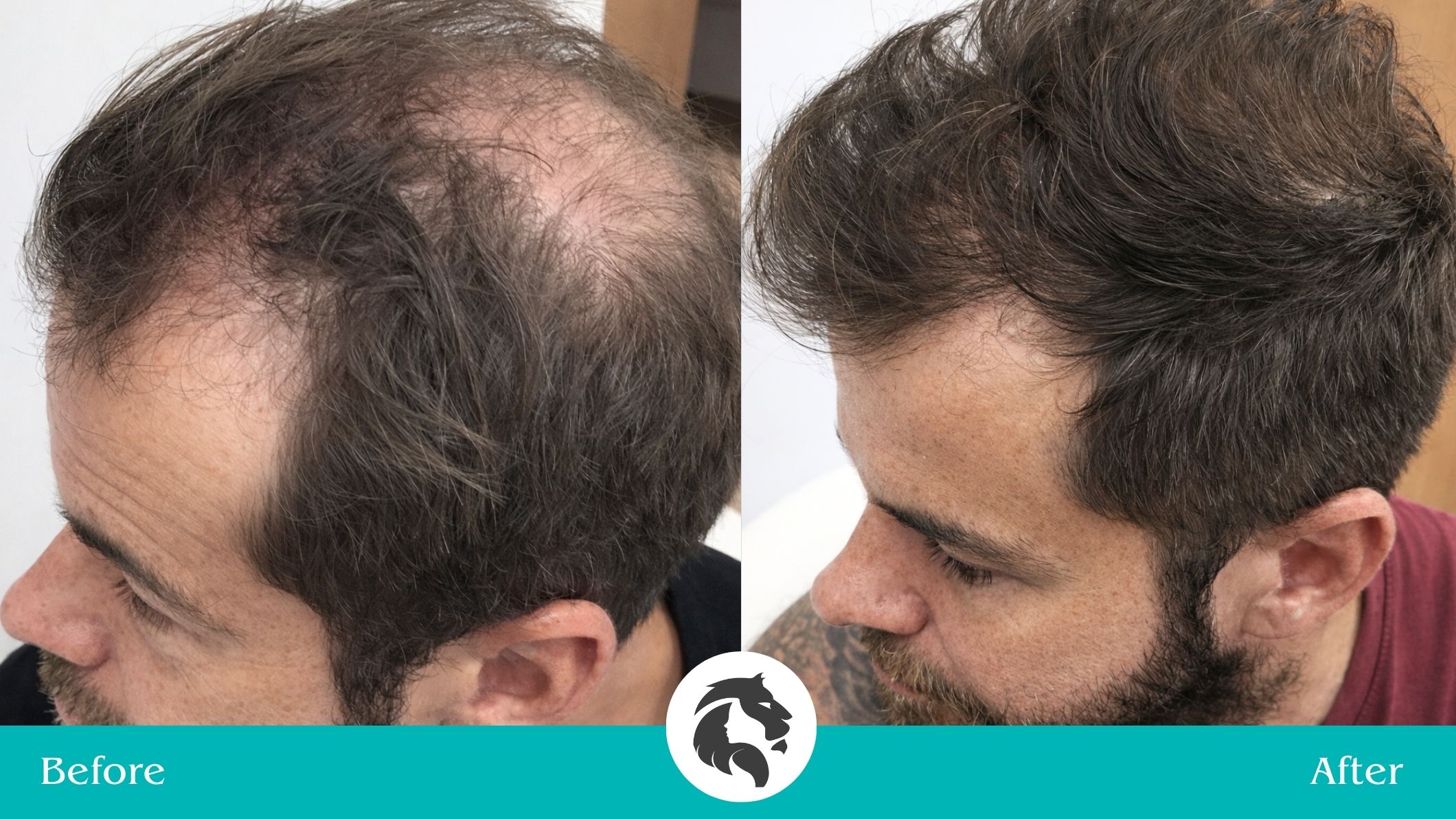 Hair transplant and medications