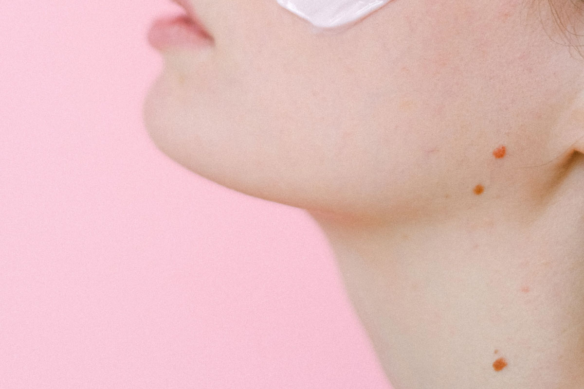 Skin-Tag-Causes-What-Is-a-Skin-Tag-Skin-Tags-Removal