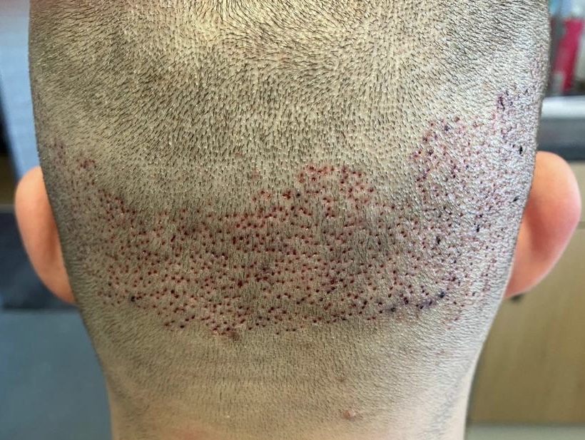 hair transplant scar