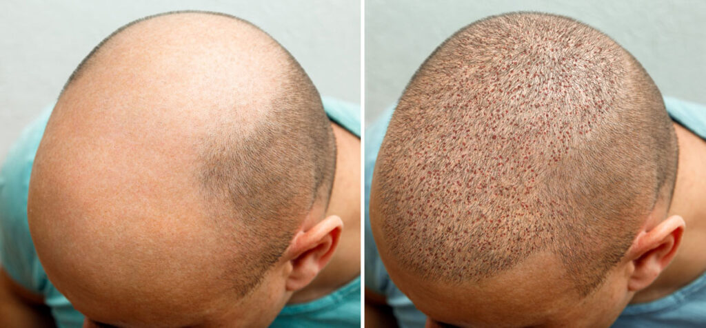 Hair Transplant Timeline