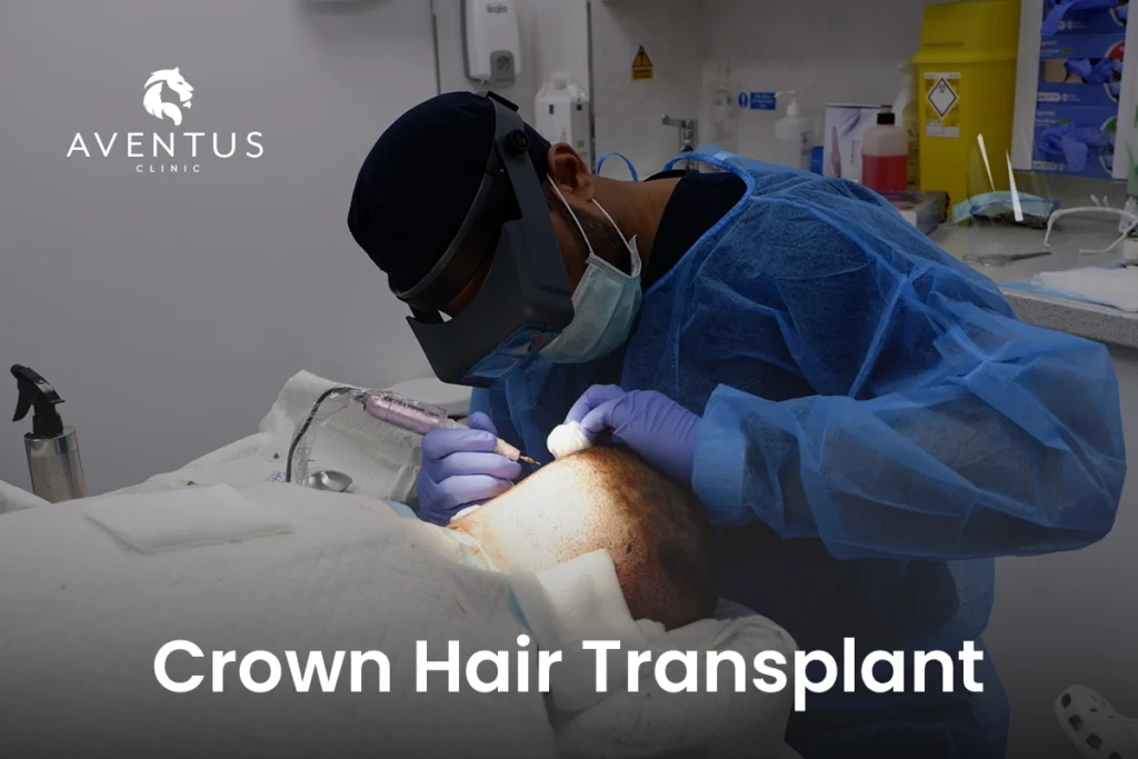 Crown Hair Transplant
