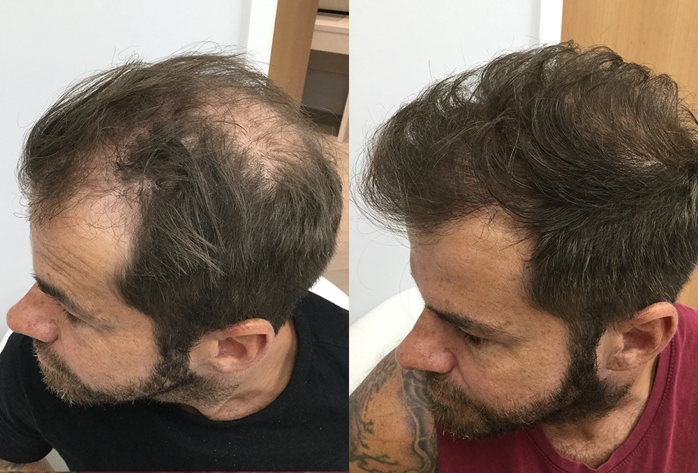 Crown Hair Transplant Before And After