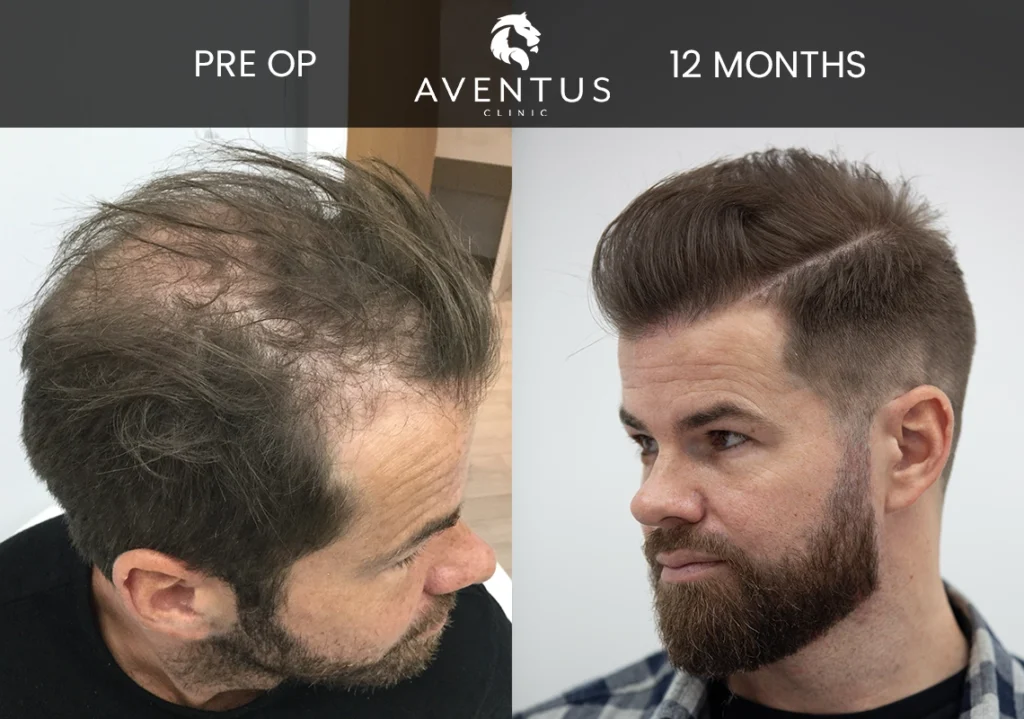 Owen-After-12-Months