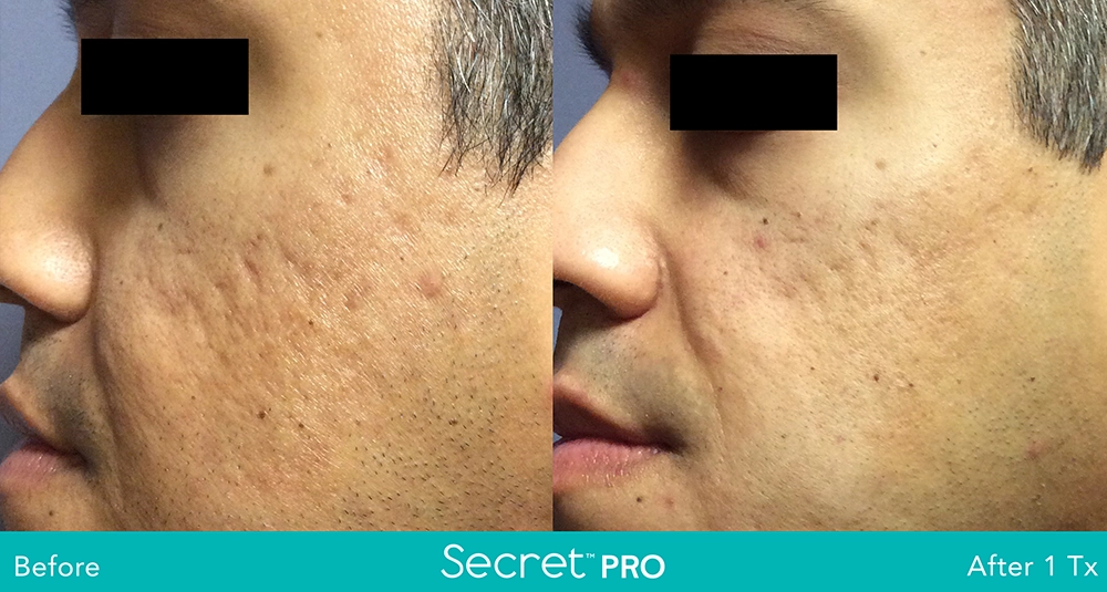 Secret Pro Before And After1