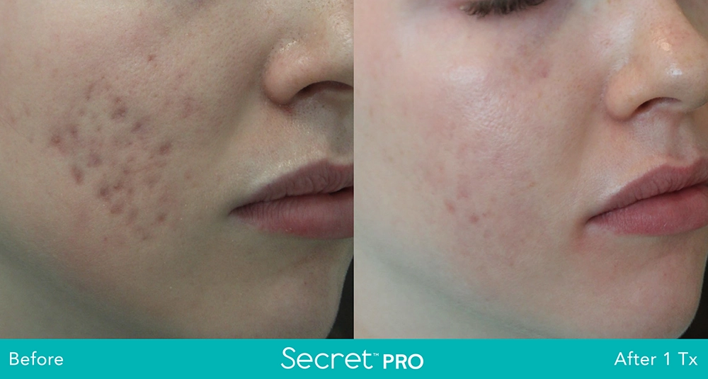 Secret Pro Before And After10