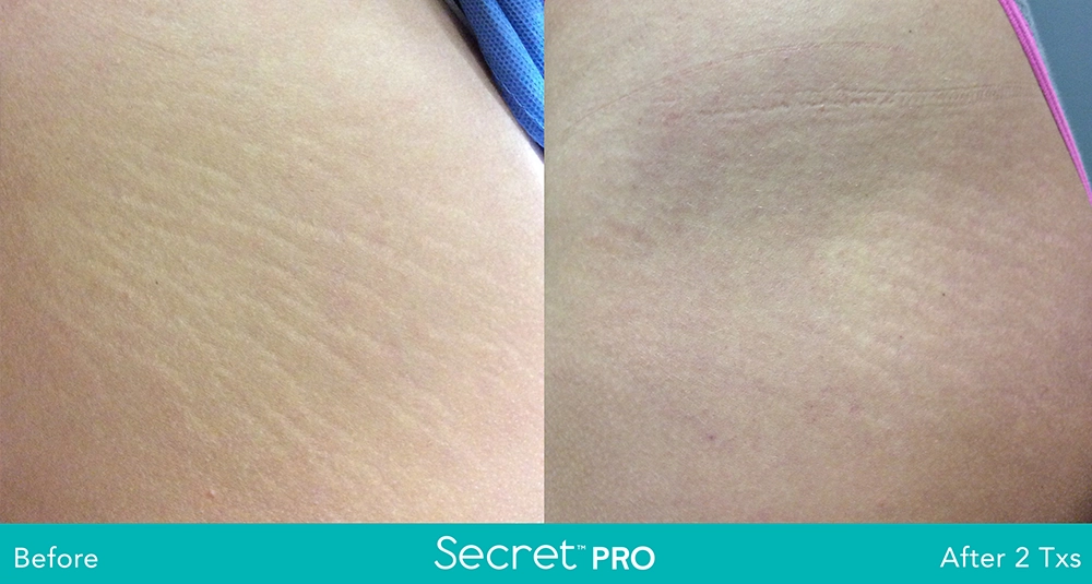 Secret Pro Before And After3