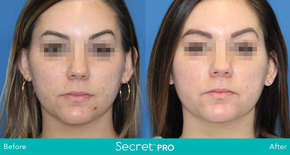 Secret Pro Before And After8