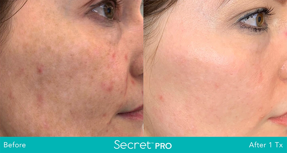 Secret Pro Before And After9