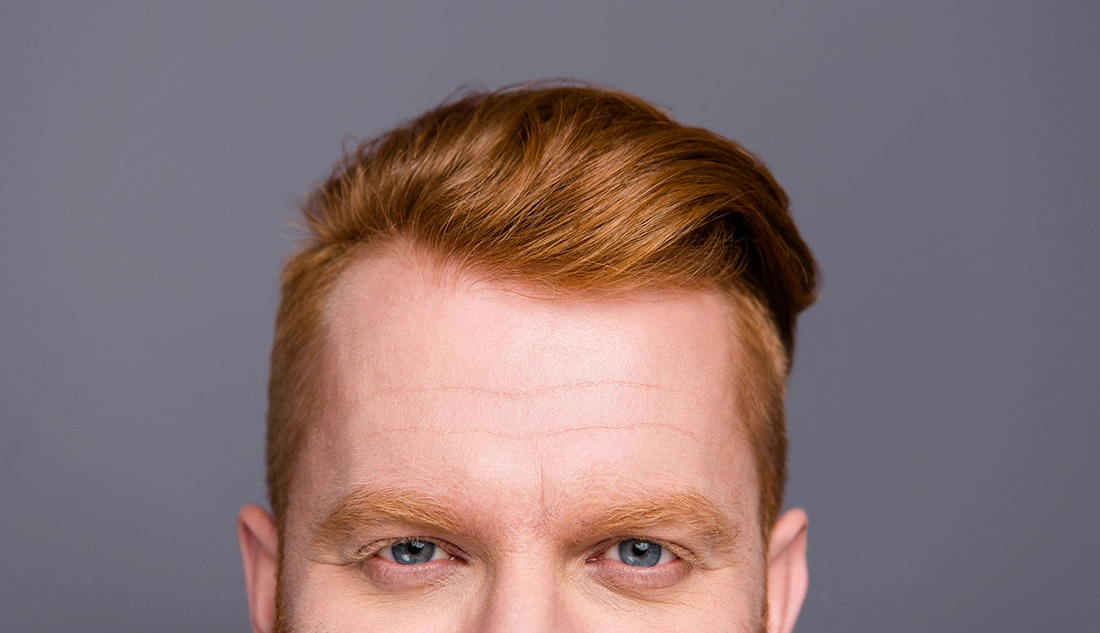 Photo of a ginger haired man, suffering with a unevening hairline