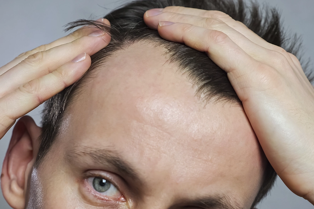Young man with a receding hairline