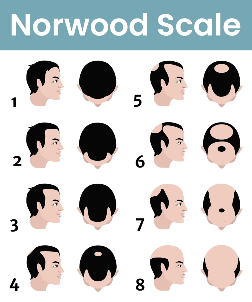 Norwood Scale