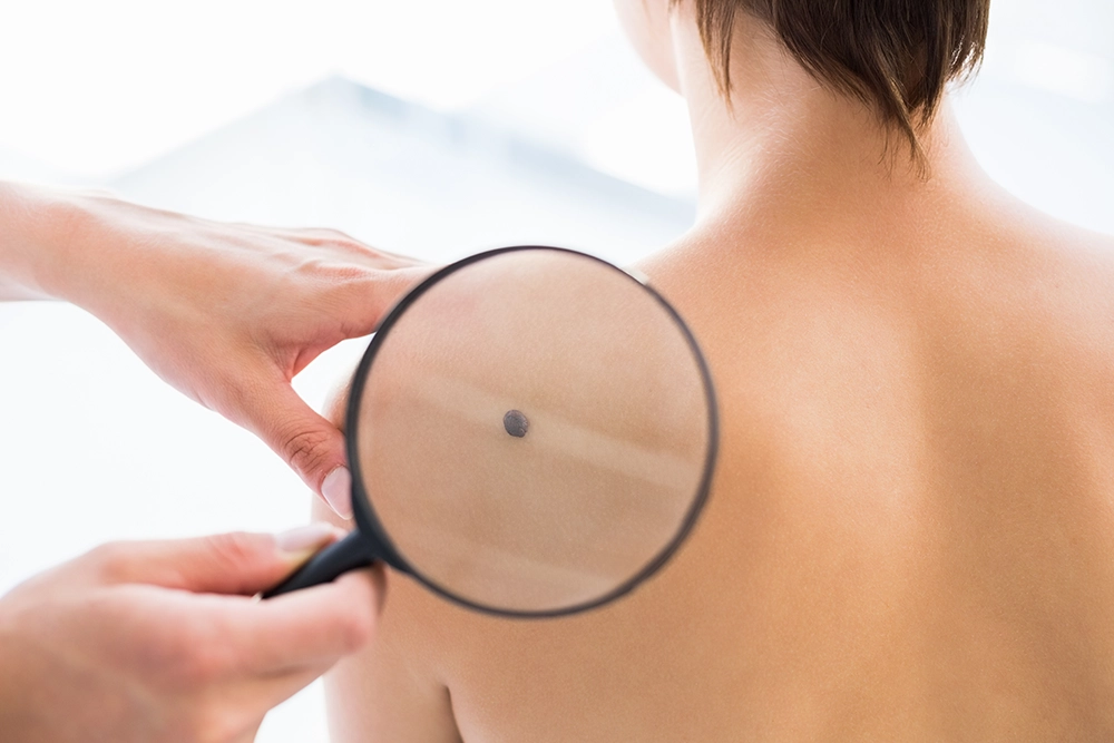 How To Get Rid Of Moles