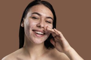 Does Drinking Water Help Acne: Exploring Its Impact on Skin Health