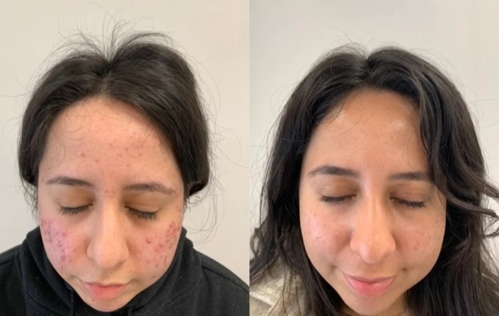 Acne-Before-And-After