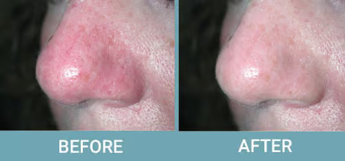 Facial-Thread-Vein-Removal-before-after-1