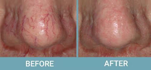 Facial-Thread-Vein-Removal-before-after1-1