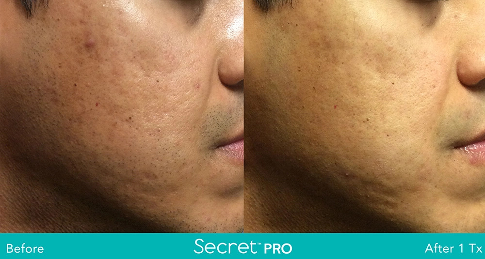 Secret-Pro-Before-And-After