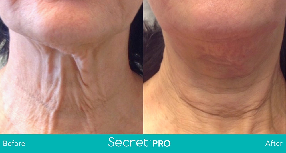 Secret-Pro-Before-And-After5