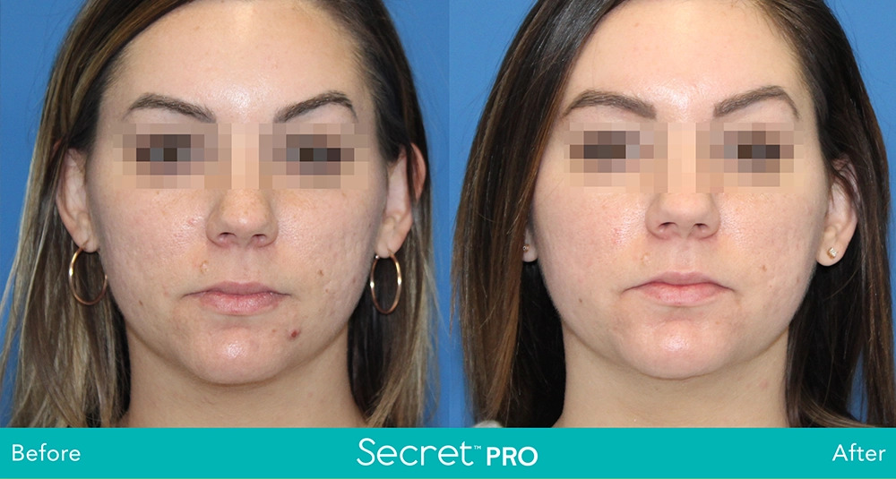 Secret-Pro-Before-And-After8