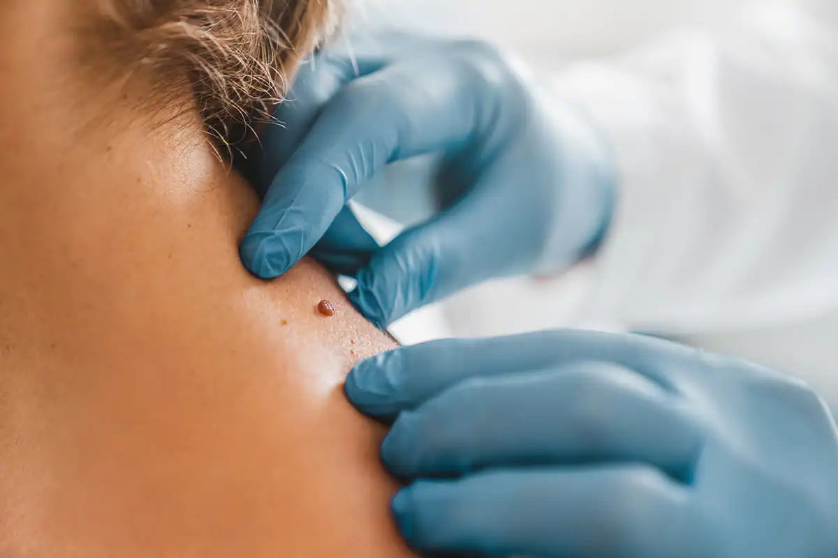 Skin Tag On Neck