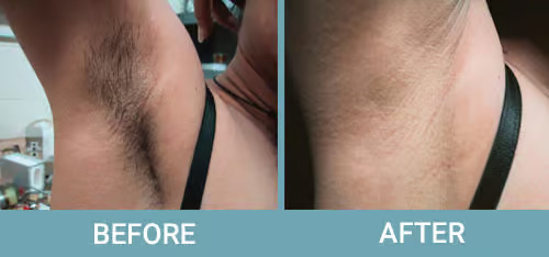 laser-hair-before-3