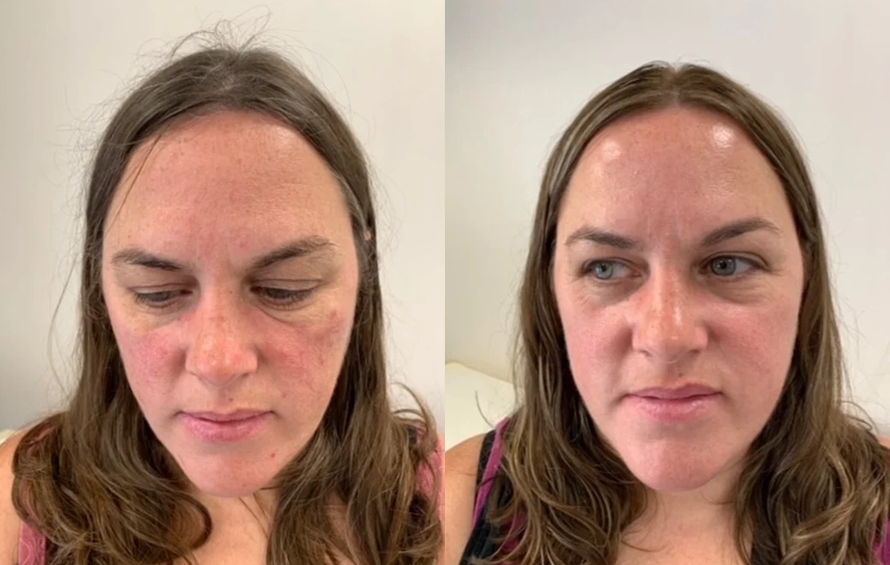 rosacea before and after treatment