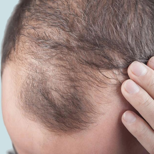 Male Pattern Baldness