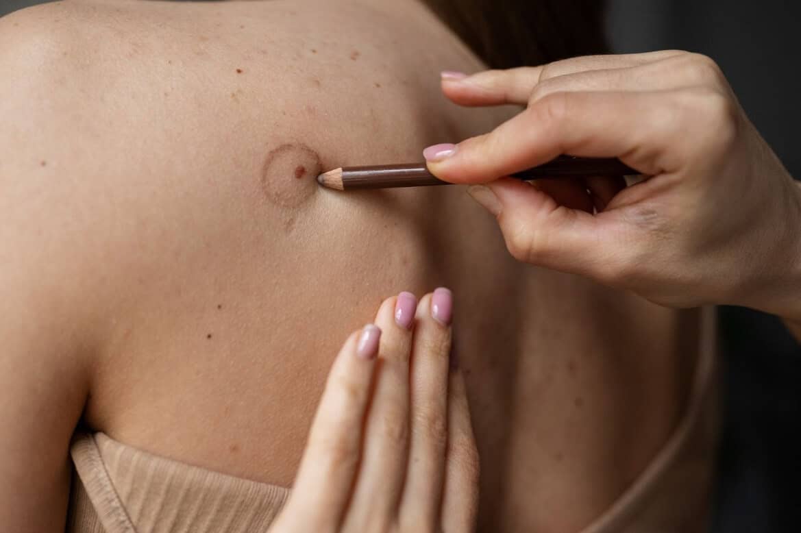 Mole assessments