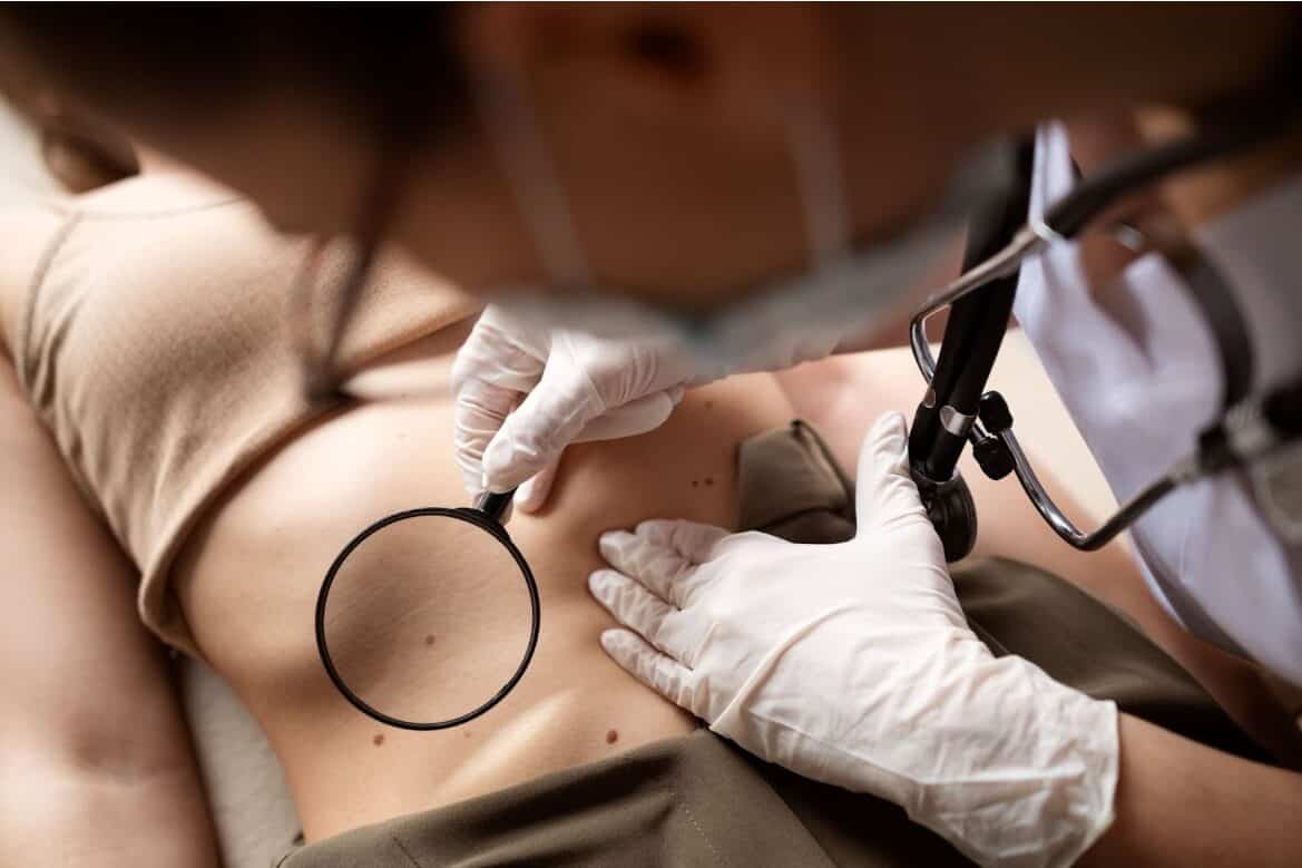 mole removal treatment