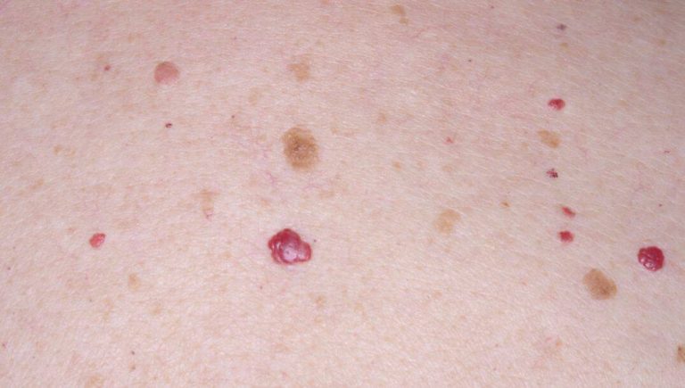 Cherry Angioma: Red Skin Spots, Diagnosis and Treatment