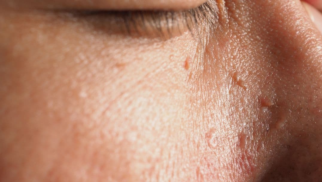 flat warts on the face