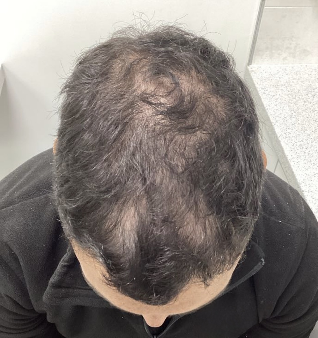 before non surgical hair treatment