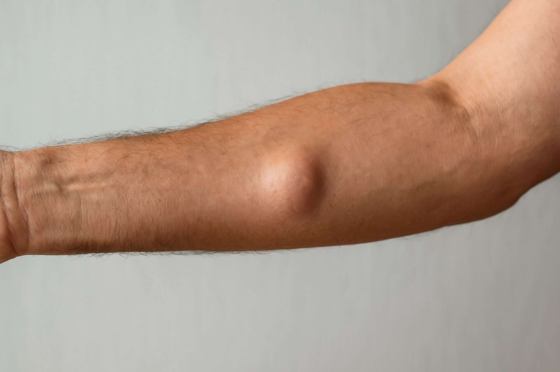 Lump on arms