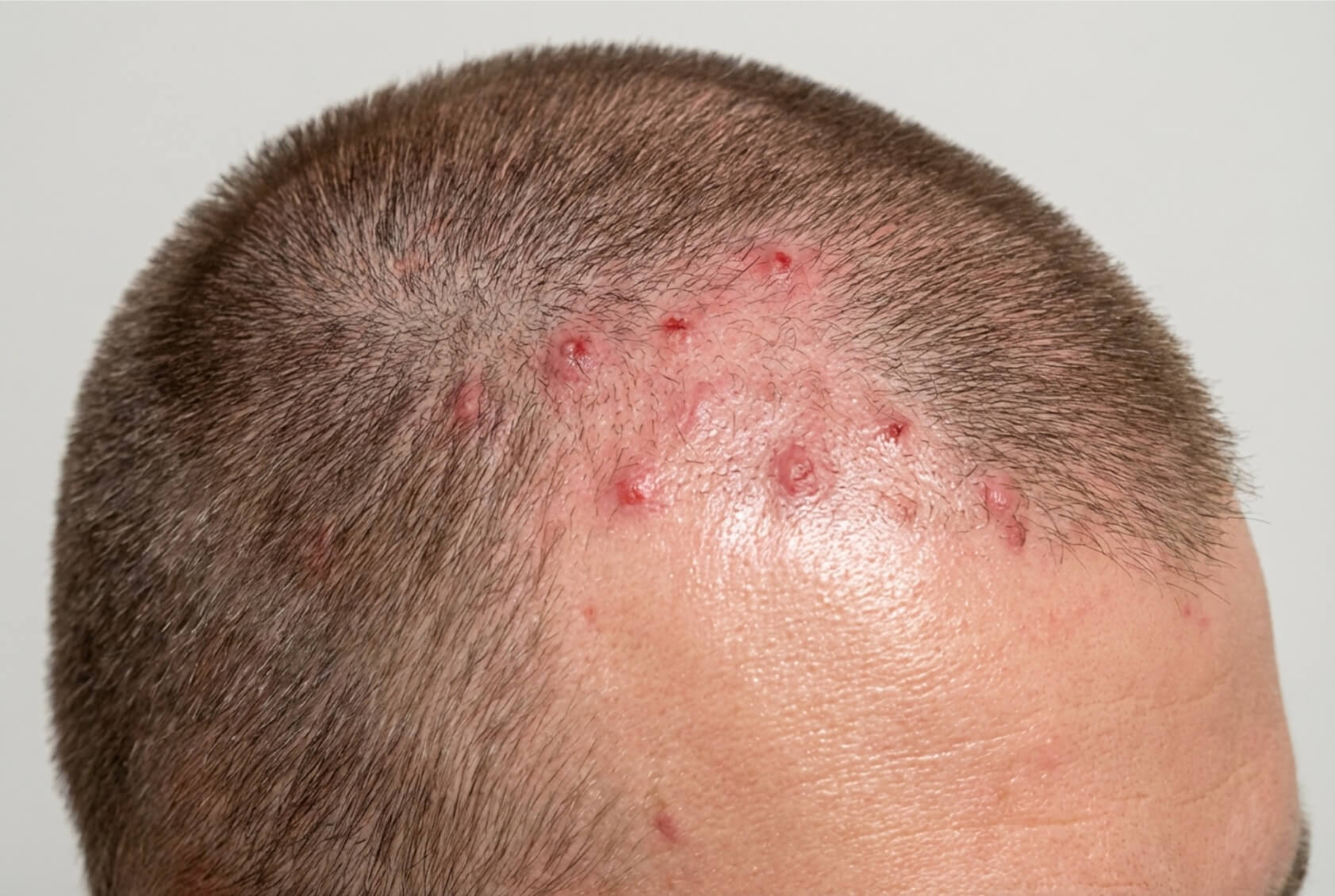 red sports on scalp
