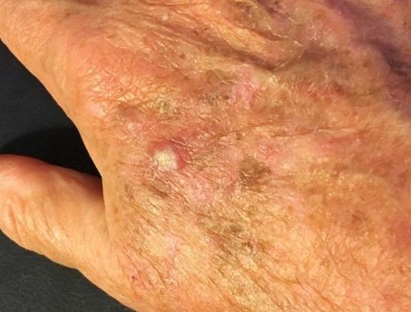 Actinic keratosis - precursor to squamous cell skin cancer