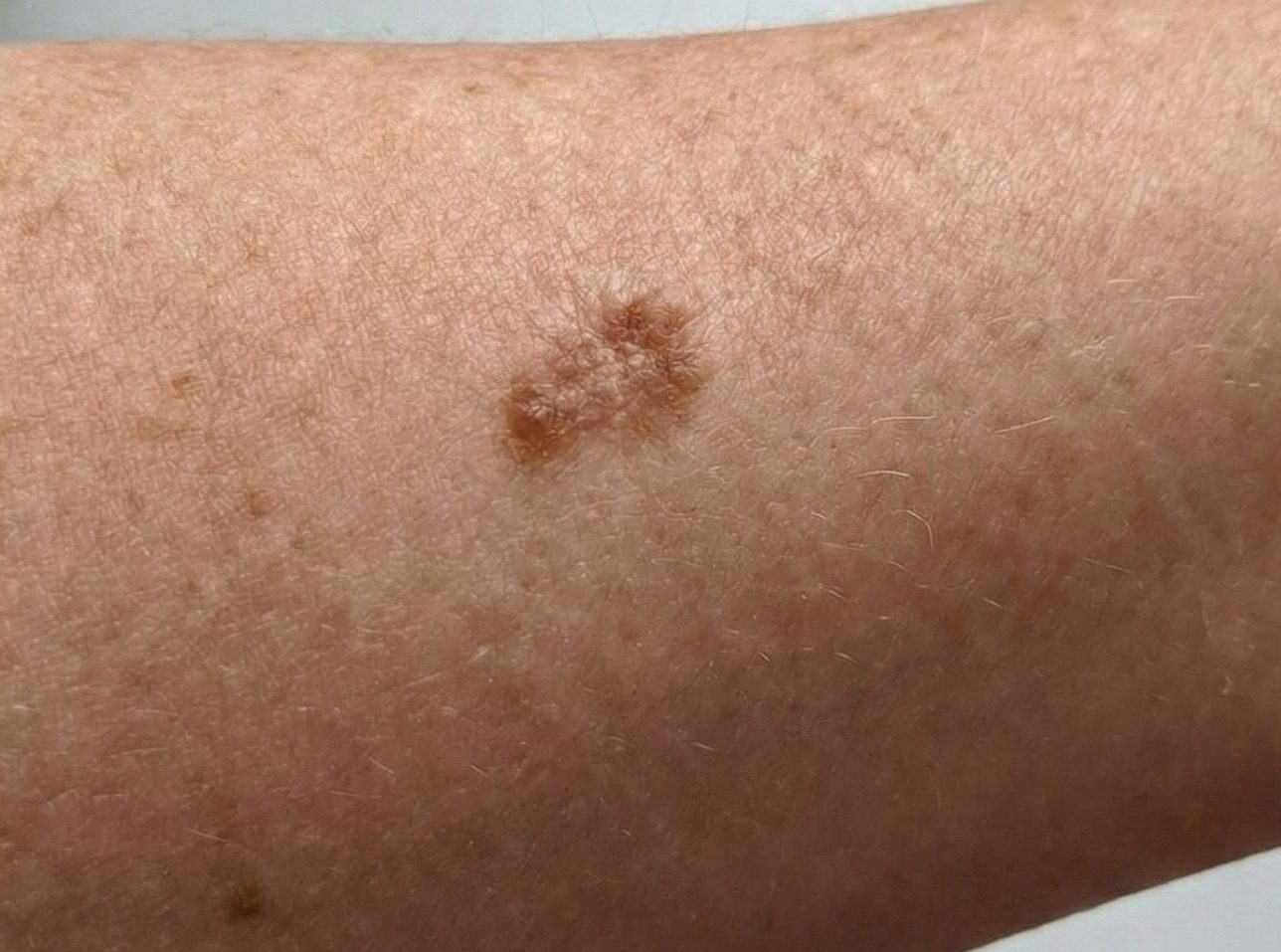 non melanoma and melanoma skin cancer