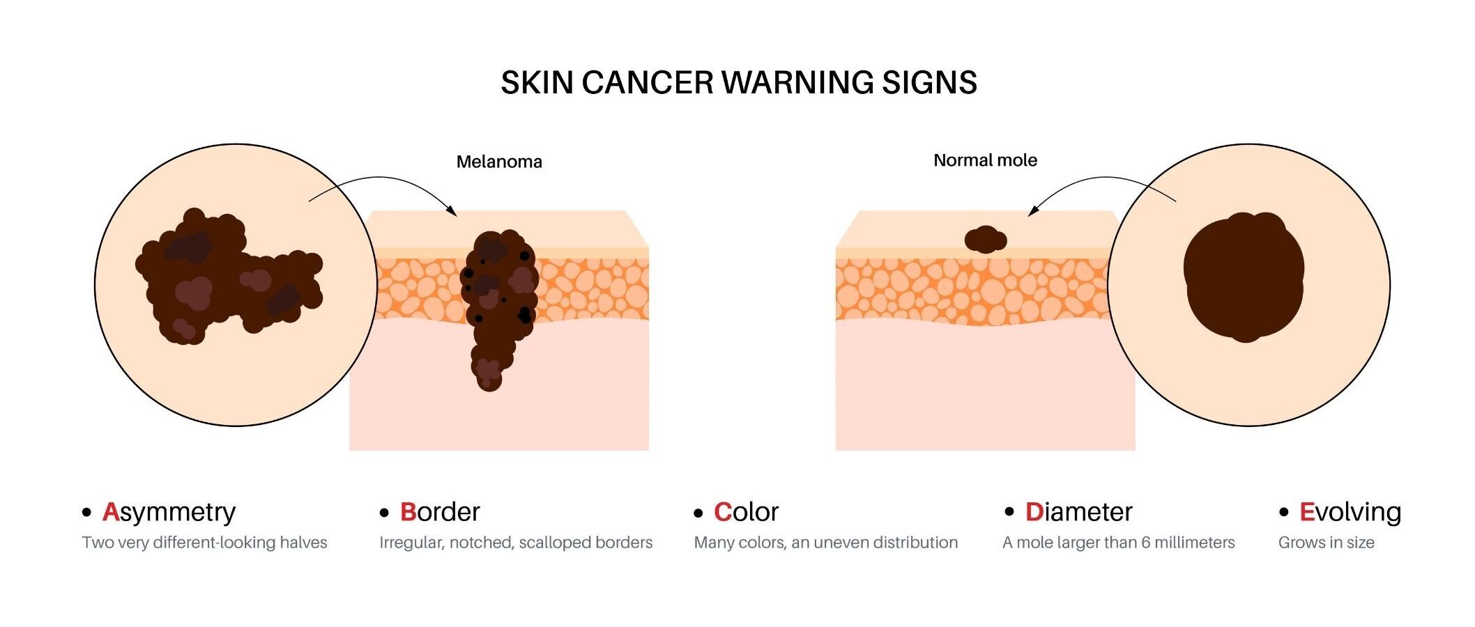 Skin Cancer Warning Signs