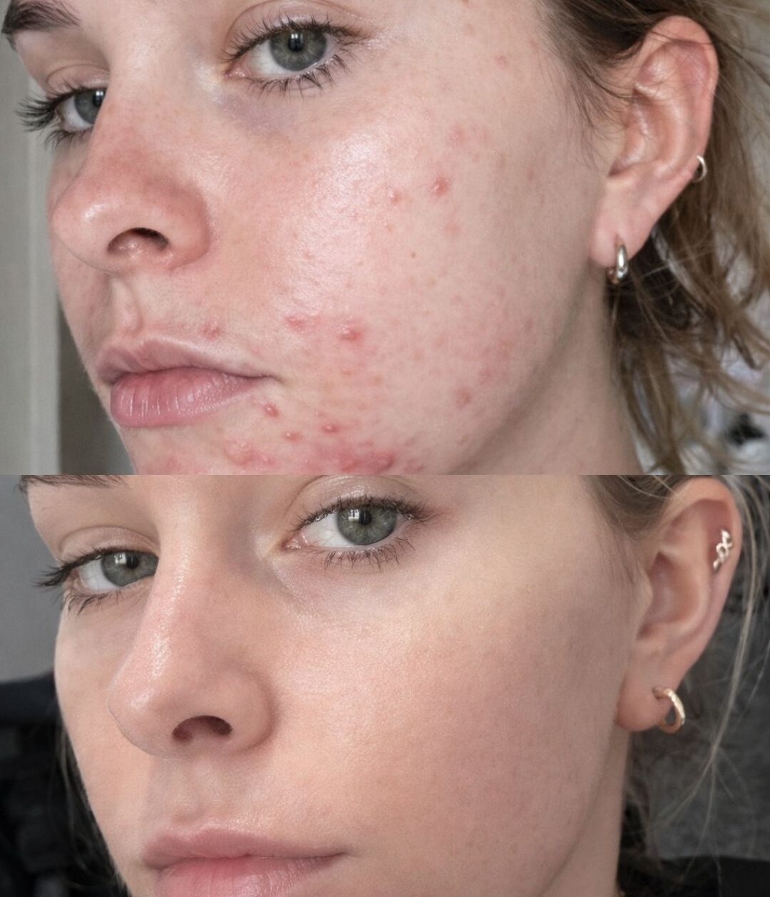 acne before and after treatment