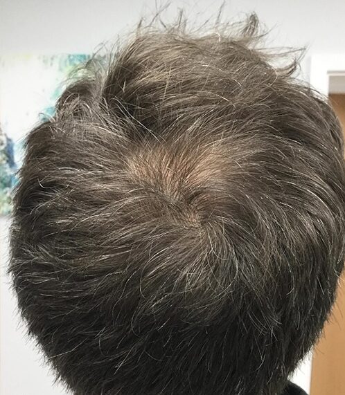 balding crown after crown hair transplant