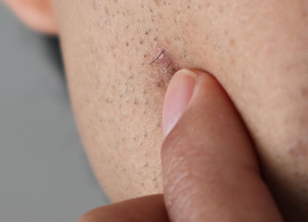 ingrown hair in beard