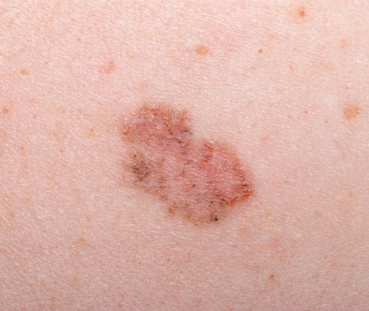 superficial basal cell carcinoma (BCC)