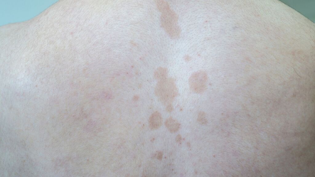 man with Tinea versicolor
