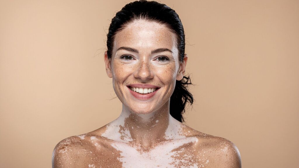 woman with vitiligo
