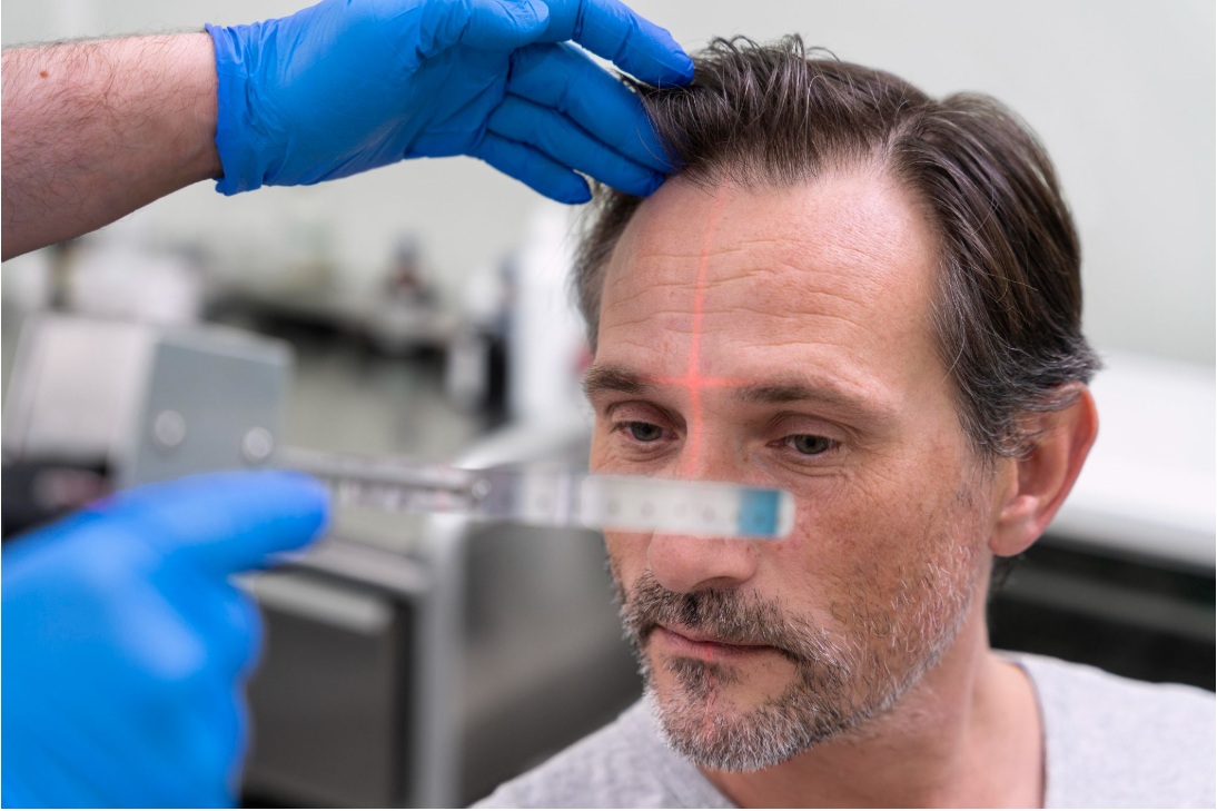 Hair Transplant for Smokers