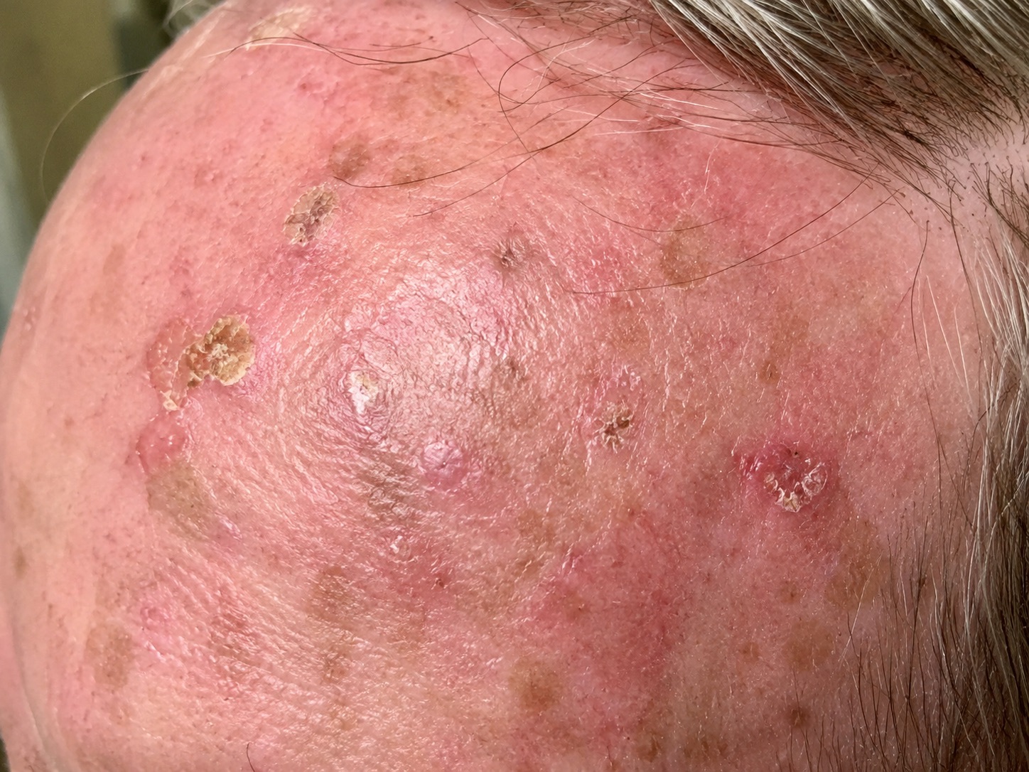 actinic keratoses