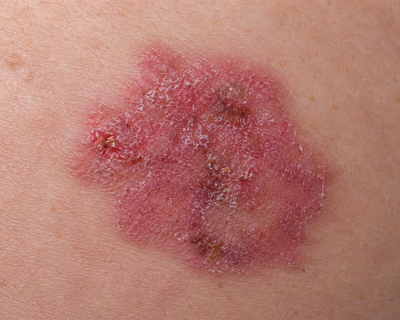 scaly lesion of bowens disease
