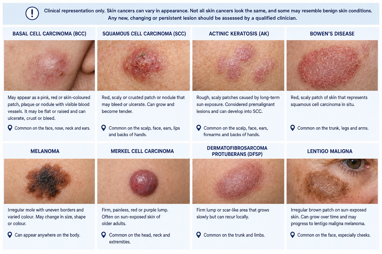 what does Skin cancers looks like reference