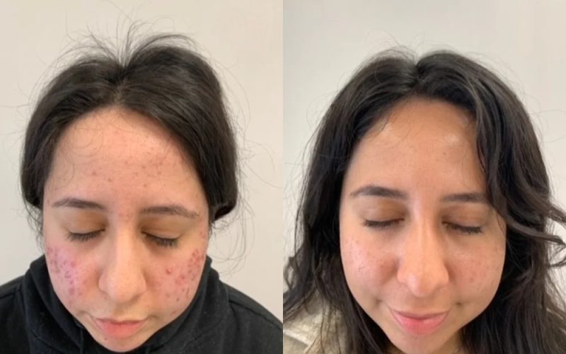 Acne-Before-And-After