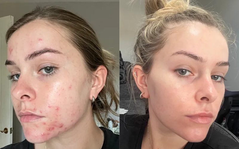 Acne-Before-And-After1
