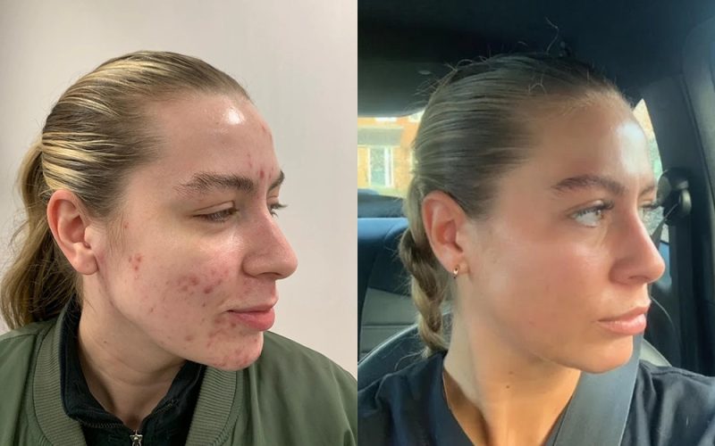 Acne-Before-And-After3